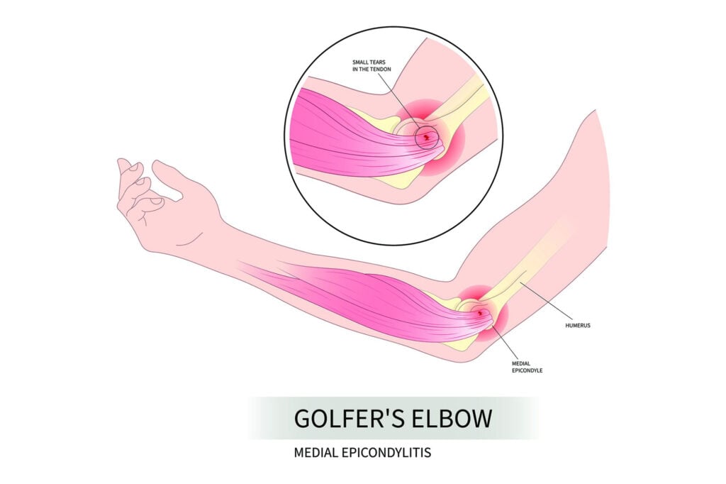 golfers elbow